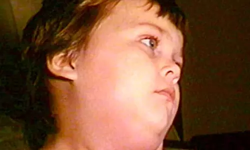 தமிழகத்தில் குழந்தைகளிடையே பரவும் பொன்னுக்கு வீங்கி வைரஸ்