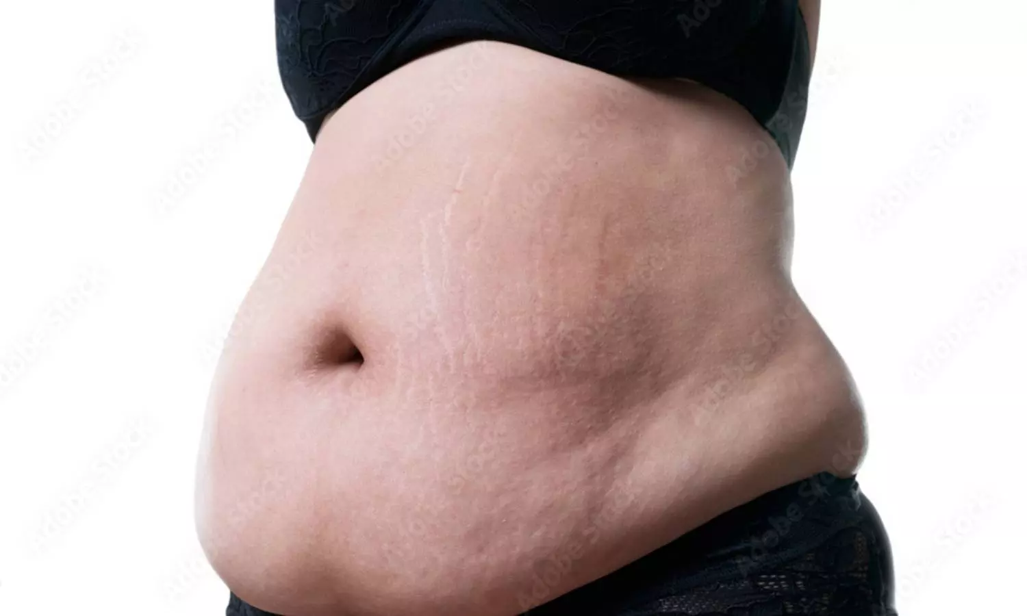 40 சதவீத பெண்களுக்கு வயிற்றுப் பருமன் பாதிப்பு- ஆய்வில் தகவல்