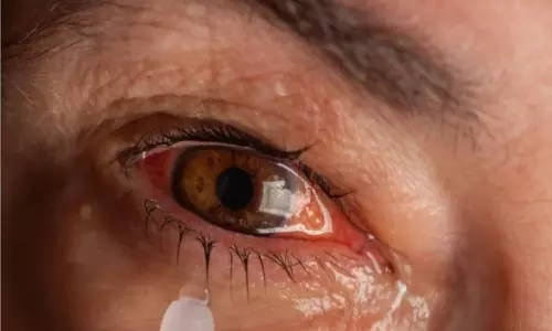 சென்னையில் `மெட்ராஸ் ஐ பரவுகிறது: டாக்டர்கள் எச்சரிக்கை