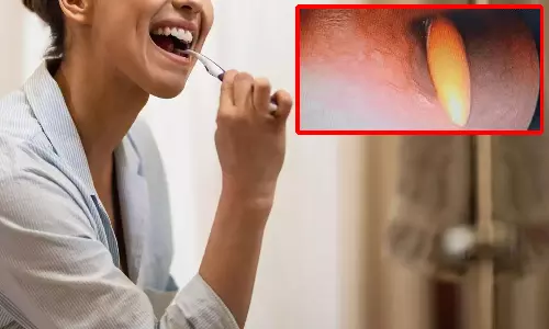 பல் துலக்கும்போது எதிர்பாரா விதமாக டூத் பிரஷை விழுங்கிய பெண்