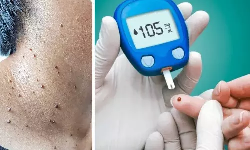 உடலில் மருக்கள் அதிகமா உள்ளதா.... சர்க்கரை நோய் ஏற்பட வாய்ப்பு அதிகம்