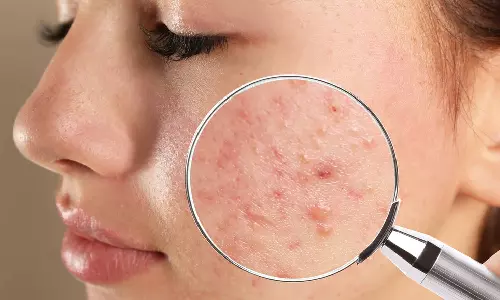 முகப்பரு பிரச்சனையா? கவலையை விடுங்க இத ட்ரை பண்ணுங்க!