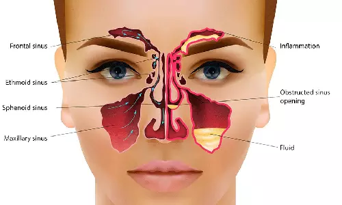 சைனசைட்டிஸ் பிரச்சினை என்றால் என்ன?