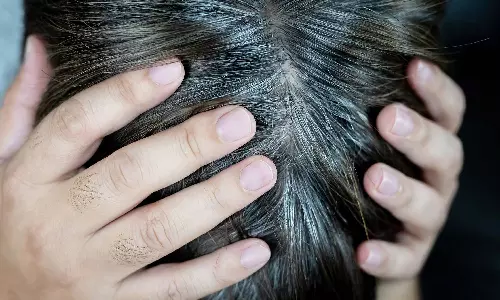 இள நரையை இயற்கையான முறையில் போக்குவது எப்படி?