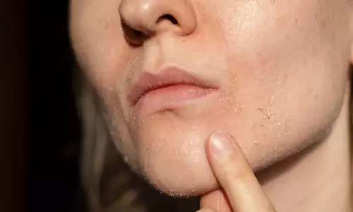 குளிர்காலத்தில் சருமத்தில் ஏற்படும் அரிப்பை போக்குவது எப்படி?