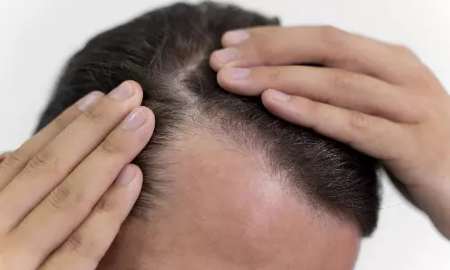 மகாராஷ்டிராவில் பரவும் மர்மநோய்: ஓரே வாரத்தில் வழுக்கையான 50 பேர்