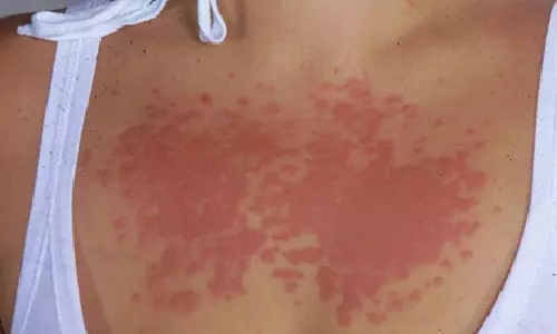 சூரிய ஒளி அலர்ஜி... இப்படி கூட சரும ஒவ்வாமை வருமா?