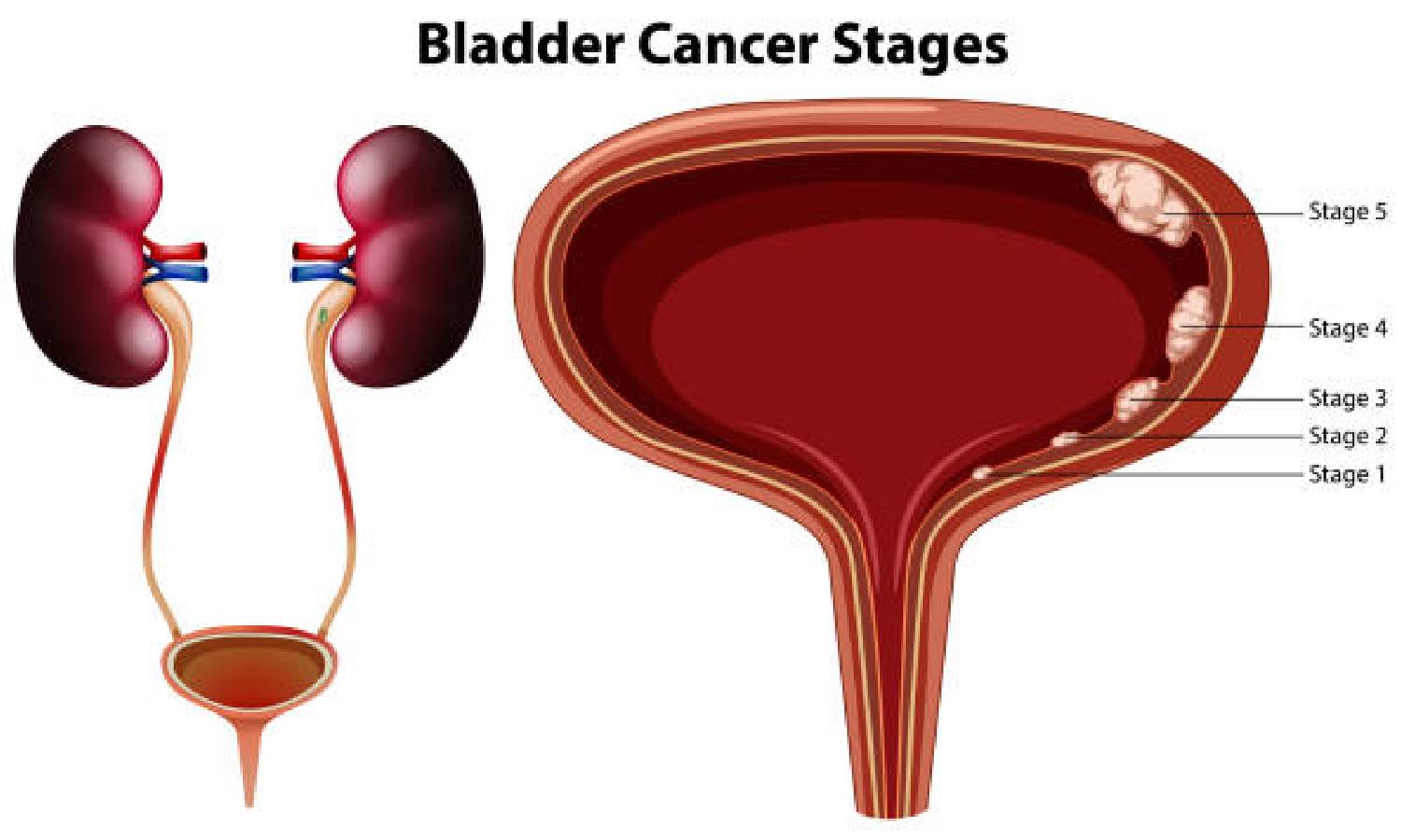 சிறுநீர்பை புற்றுநோய் தடுக்க புதிய சிகிச்சை