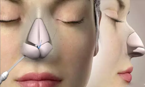 முக அழகை மேம்படுத்தும் ரைனோப்ளாஸ்டி சிகிச்சை