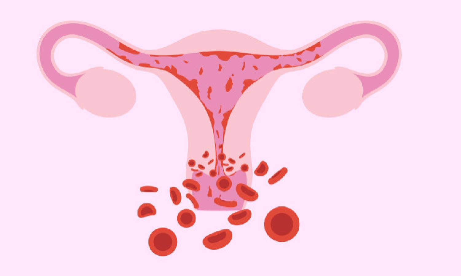 மாதவிடாய் காலத்தில் அதிக உதிரப்போக்கு ஏற்படுவது எதனால்?