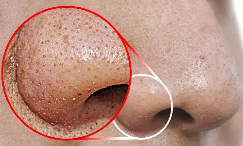 மூக்கை சுற்றி உள்ள Blackheads-சை நீக்க உதவும் பயனுள்ள குறிப்புகள்!