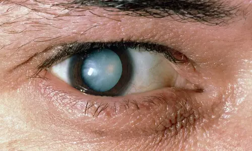 உஷார்... நீரிழிவு நோயாளிகளுக்கு கண்புரை நோய் வாய்ப்பு அதிகம்