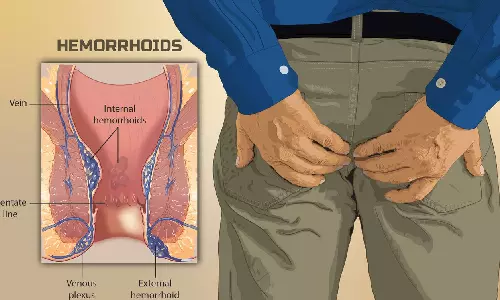 மூலநோயில் இருந்து விடுபட இத Follow பண்ணுங்க!