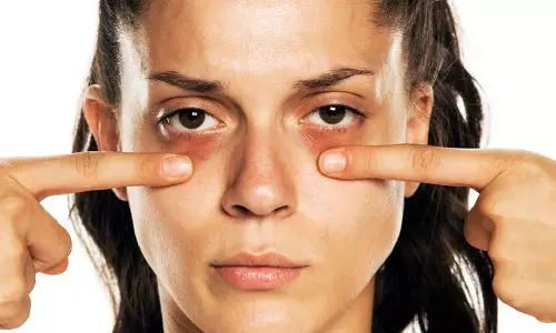 கருவளையத்தை நீக்க உதவும் வீட்டு வைத்திய குறிப்புகள்!