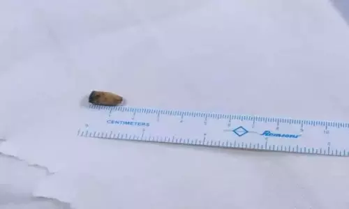 21 ஆண்டுகளாக நுரையீரலில் சிக்கிய பேனா மூடியுடன் வாழ்ந்த வாலிபர்- டாக்டர்கள் அதிர்ச்சி