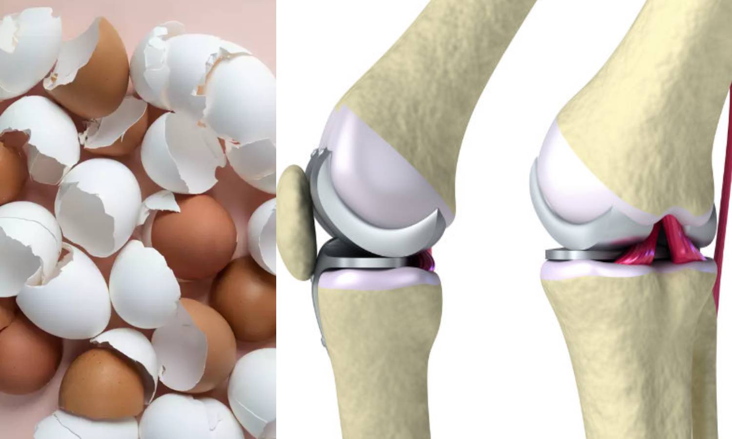 விரிசல் அடைந்த எலும்புகளை ஒட்ட முட்டை ஓடுகளில் இருந்து புதிய கண்டுபிடிப்பு