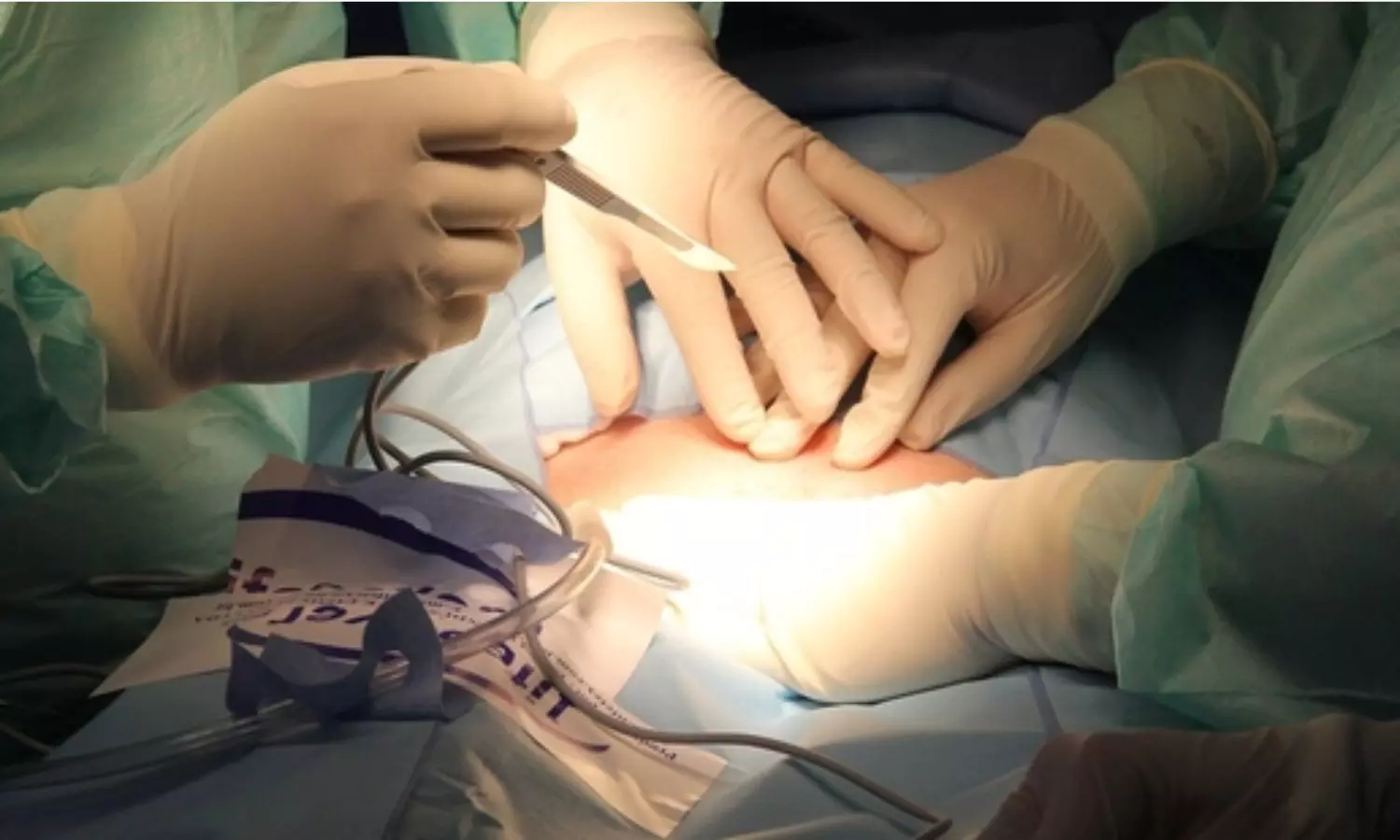 பெண்ணின் வயிற்றுக்குள் வைத்து தைக்கப்பட்ட Surgical Mop.. மகப்பேறு அறுவை சிகிச்சையில் விபரீதம்