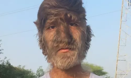 முகம் முழுக்க முடி.. கின்னஸில் இடம்பிடித்த இந்திய இளைஞர்..!