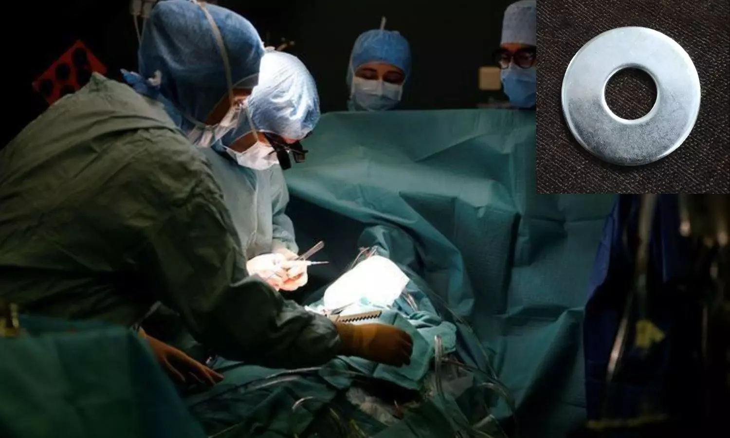 பிறப்பு உறுப்பில் சிக்கிய இரும்பு வாஷர்.. மலைத்த மருத்துவர்கள் - வெட்டி எடுத்த தீயணைப்பு வீரர்கள்!