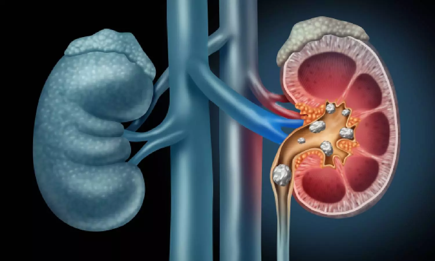 சிறுநீரக கற்கள் எதனால் உருவாகின்றன? எப்படி தடுப்பது?