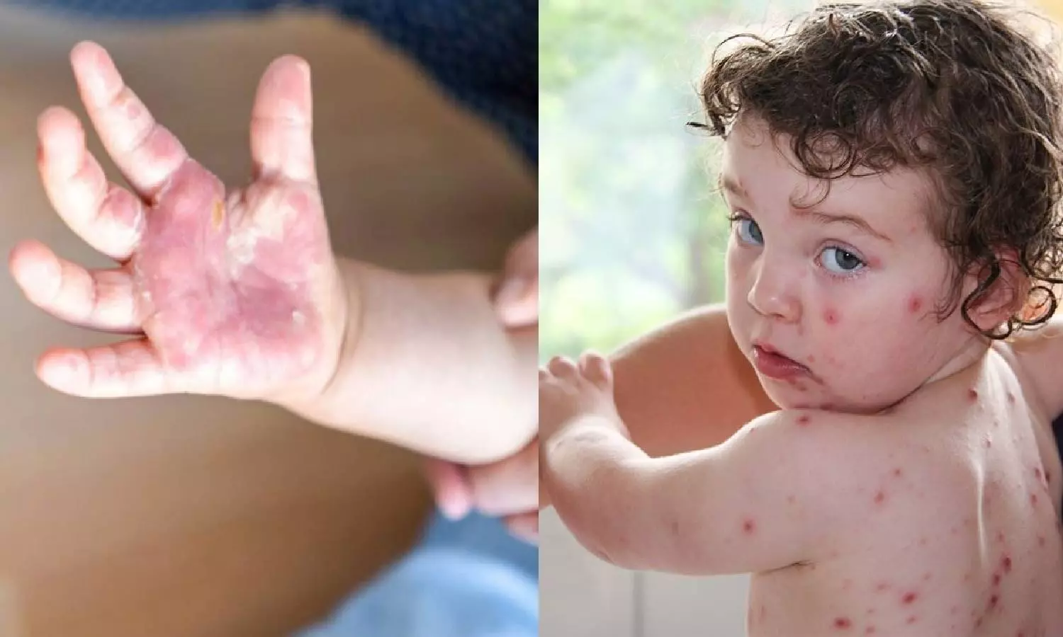 குழந்தைகளை தாக்கும் `தக்காளி காய்ச்சல்- டாக்டர்கள் எச்சரிக்கை