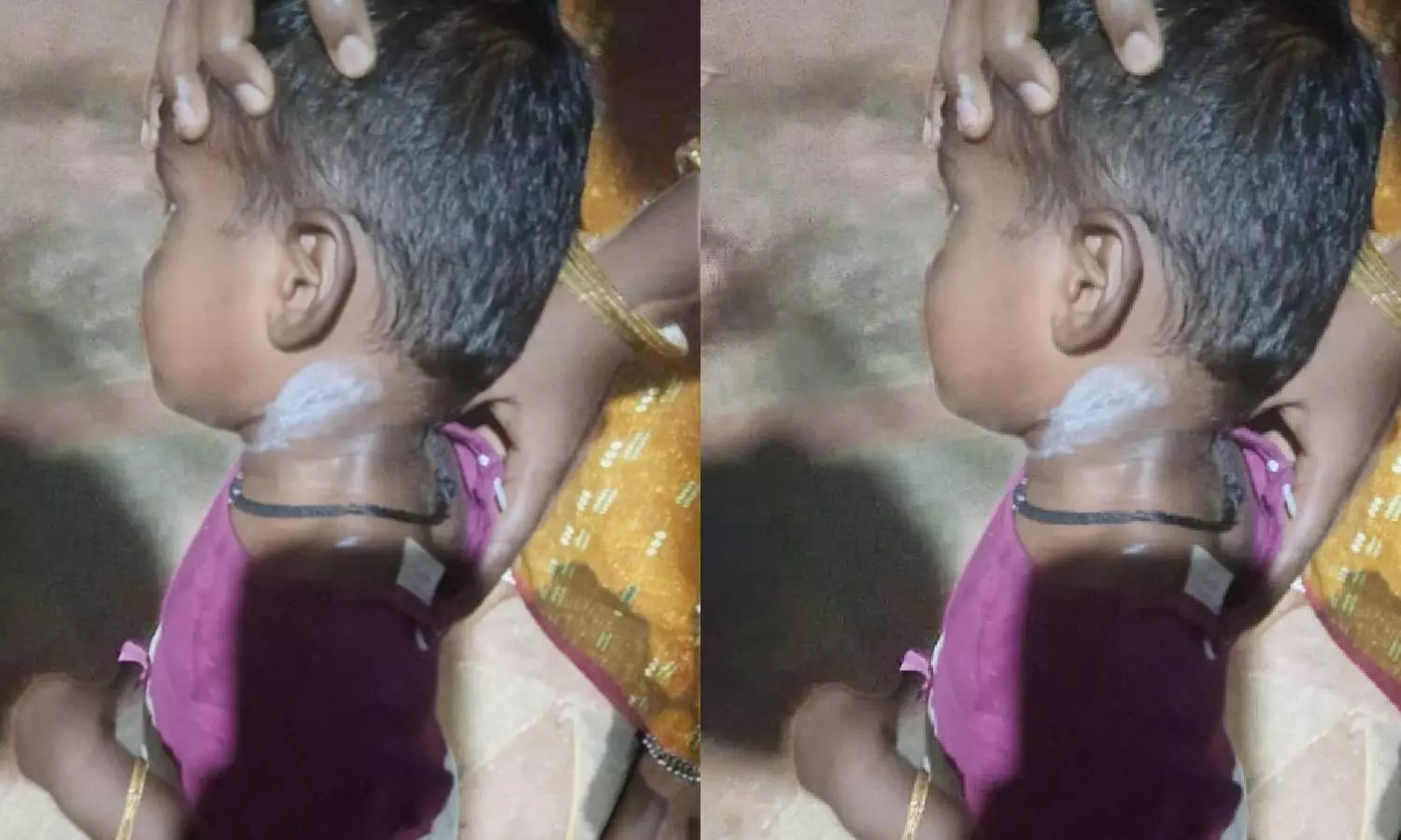 2½ வயது குழந்தைக்கு சூடு வைத்த அங்கன்வாடி ஊழியர்