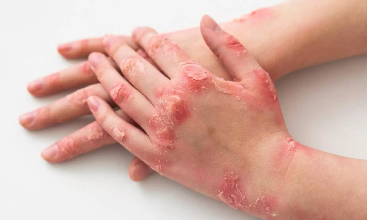 வியர்க்குருவிற்கும் சர்க்கரை நோய்க்கும் இடையே தொடர்பு இருக்கிறதா?