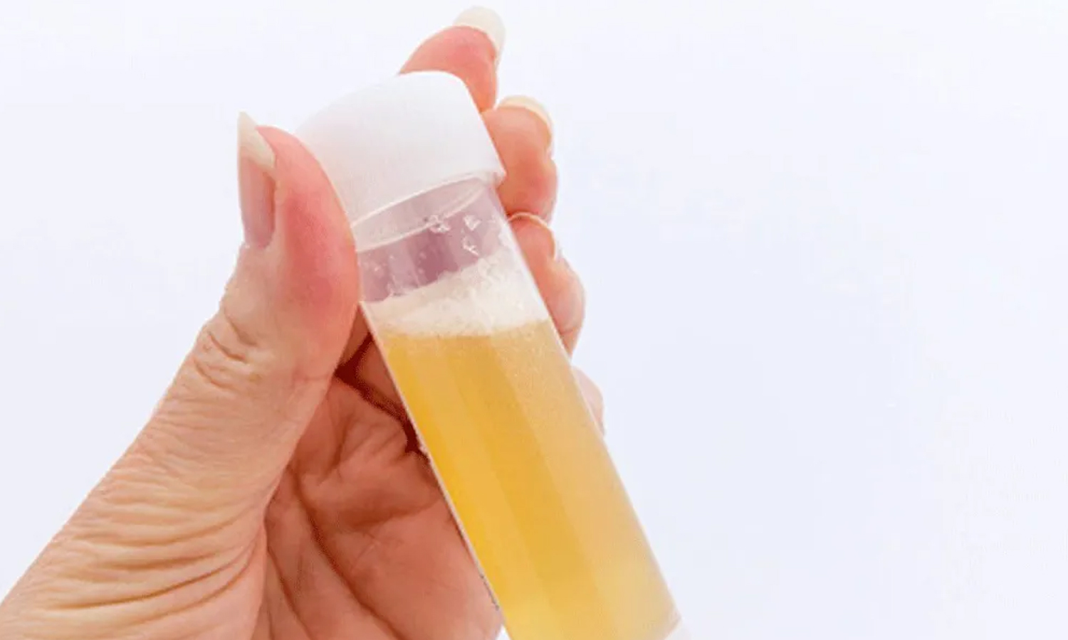 சிறுநீரில் வெள்ளை நுரை... ஆபத்தானதா?