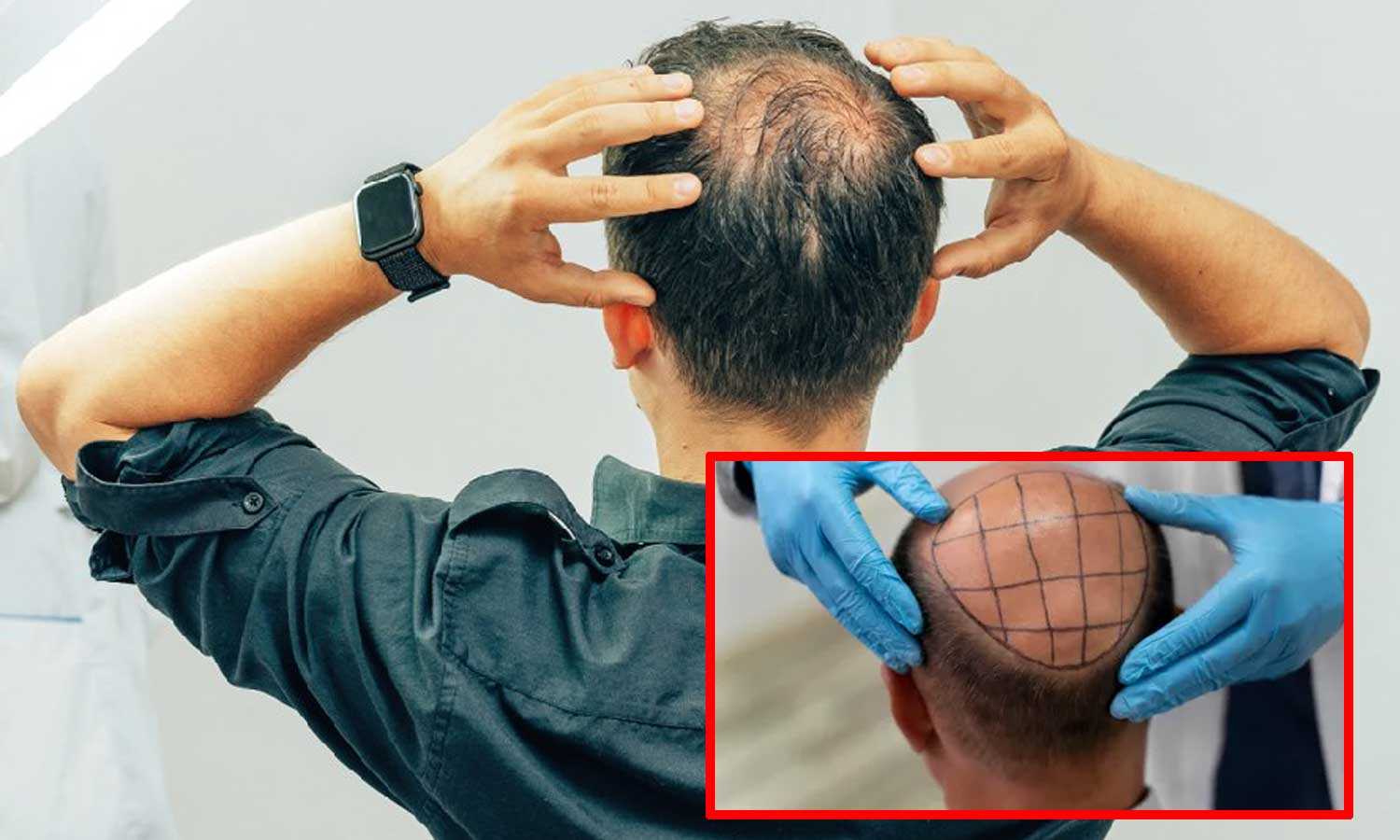 முடி மாற்று அறுவை சிகிச்சை செய்த பல் மருத்துவர் - 2 பேர் உயிரிழப்பு