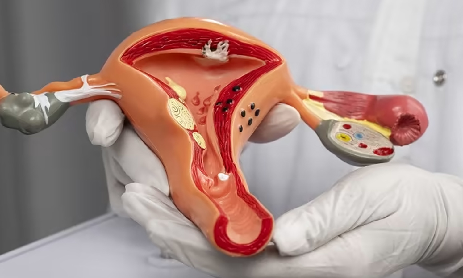 பெண்களை பாதிக்கும் கர்ப்பப்பை புற்றுநோய்க்கான காரணங்கள் பெண்களை பாதிக்கும் கர்ப்பப்பை புற்றுநோய்க்கான காரணங்கள்