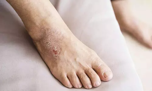 கரப்பான் வறட்சி தோல் நோய்க்கான காரணங்களும் தீர்வும்