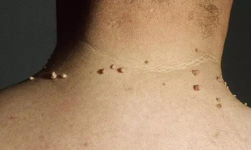 வலியே இல்லாமல் மருக்கள் மறைய சில டிப்ஸ்...