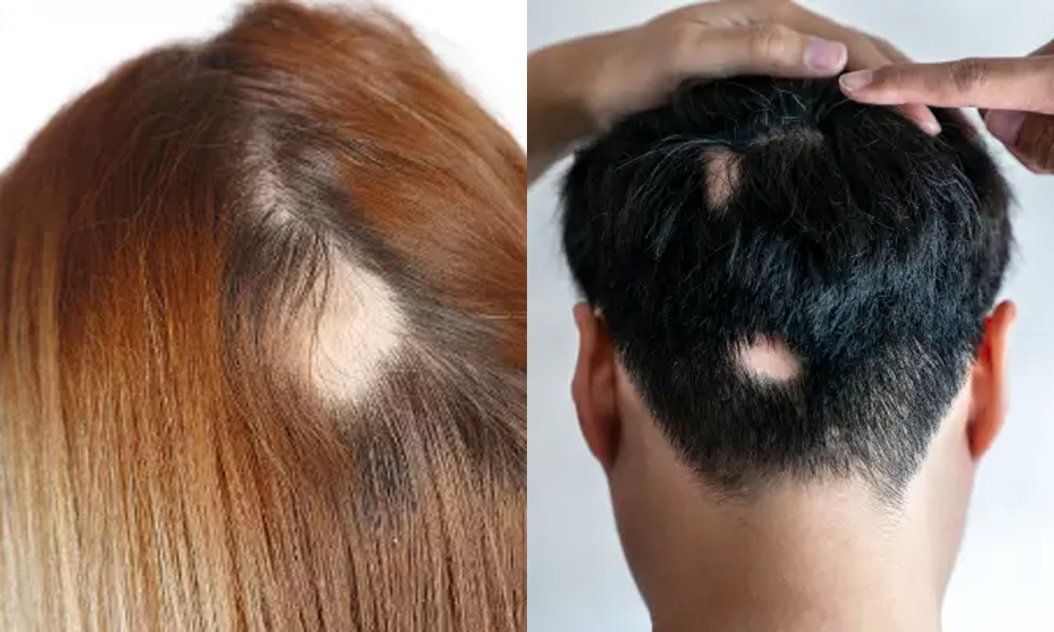 தலையில் சில இடங்களில் கொத்தாக முடி உதிர்கிறதா?