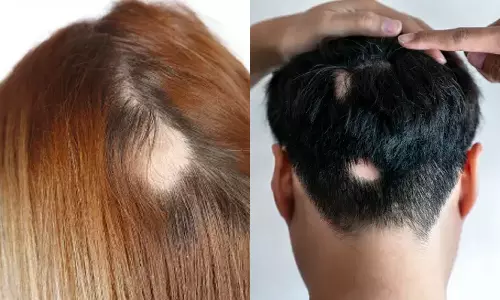 தலையில் சில இடங்களில் கொத்தாக முடி உதிர்கிறதா?