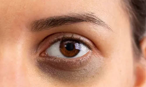 கண்ணை சுற்றி கருவளையமா கவலையை விடுங்க... உங்களுக்காக சில டிப்ஸ்