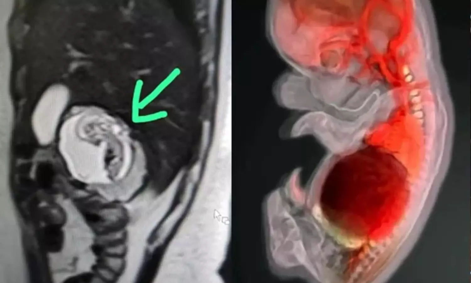 அரிதினும் அரிது: இளம்பெண்ணின் கல்லீரலுக்குள் வளரும் 3 மாத கரு.. அதிர்ந்த மருத்துவர்கள்