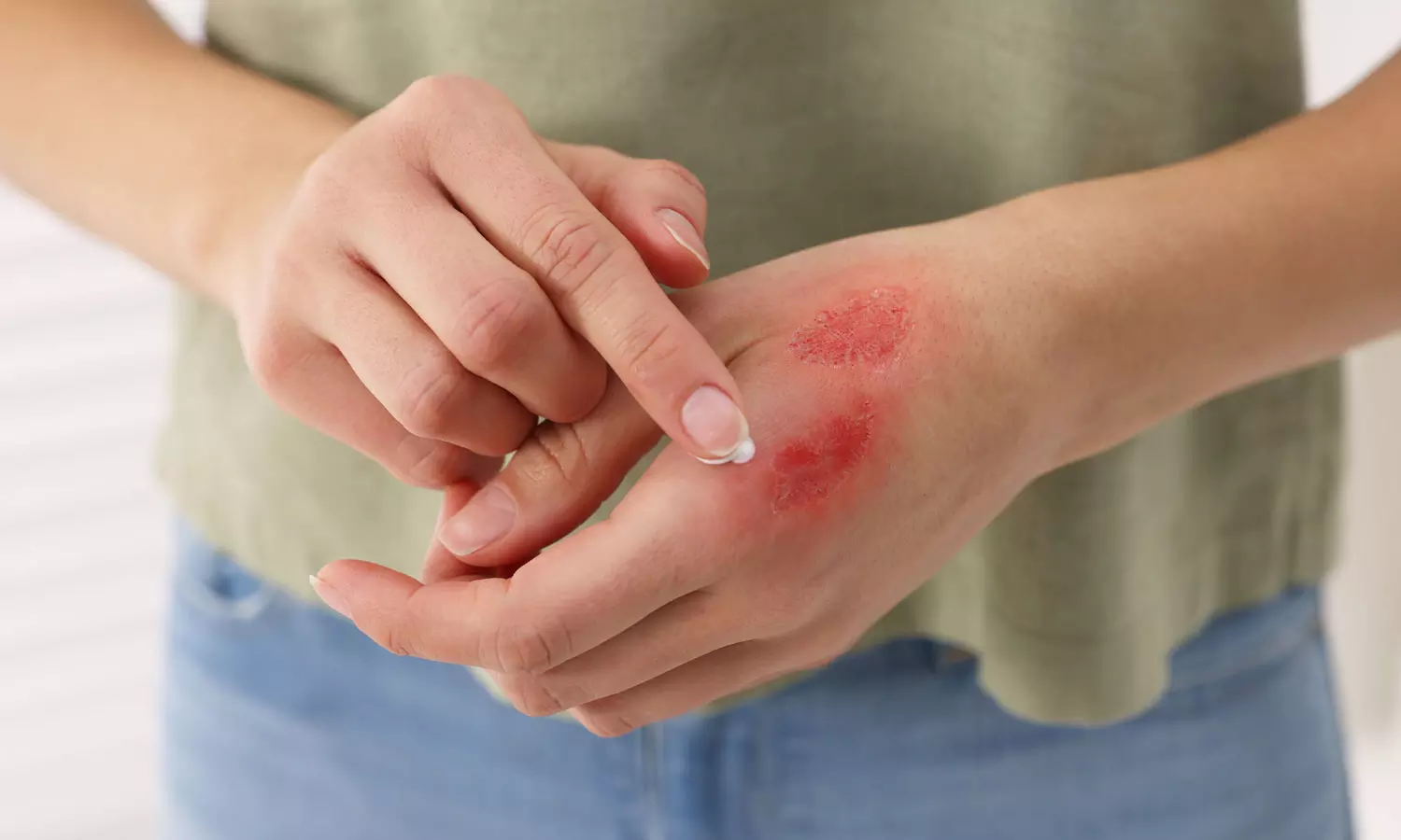 தீக்காயங்களும்… எச்சரிக்கை நடவடிக்கைகளும்...