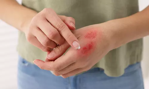 தீக்காயங்களும்… எச்சரிக்கை நடவடிக்கைகளும்...