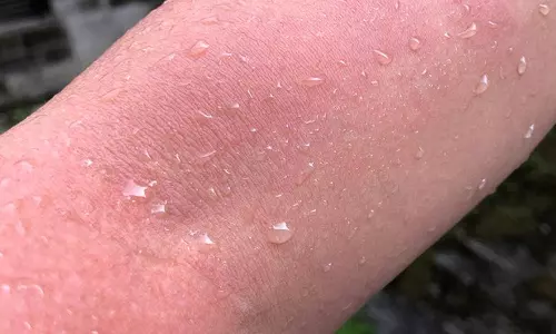 தண்ணீர் ஒவ்வாமை...