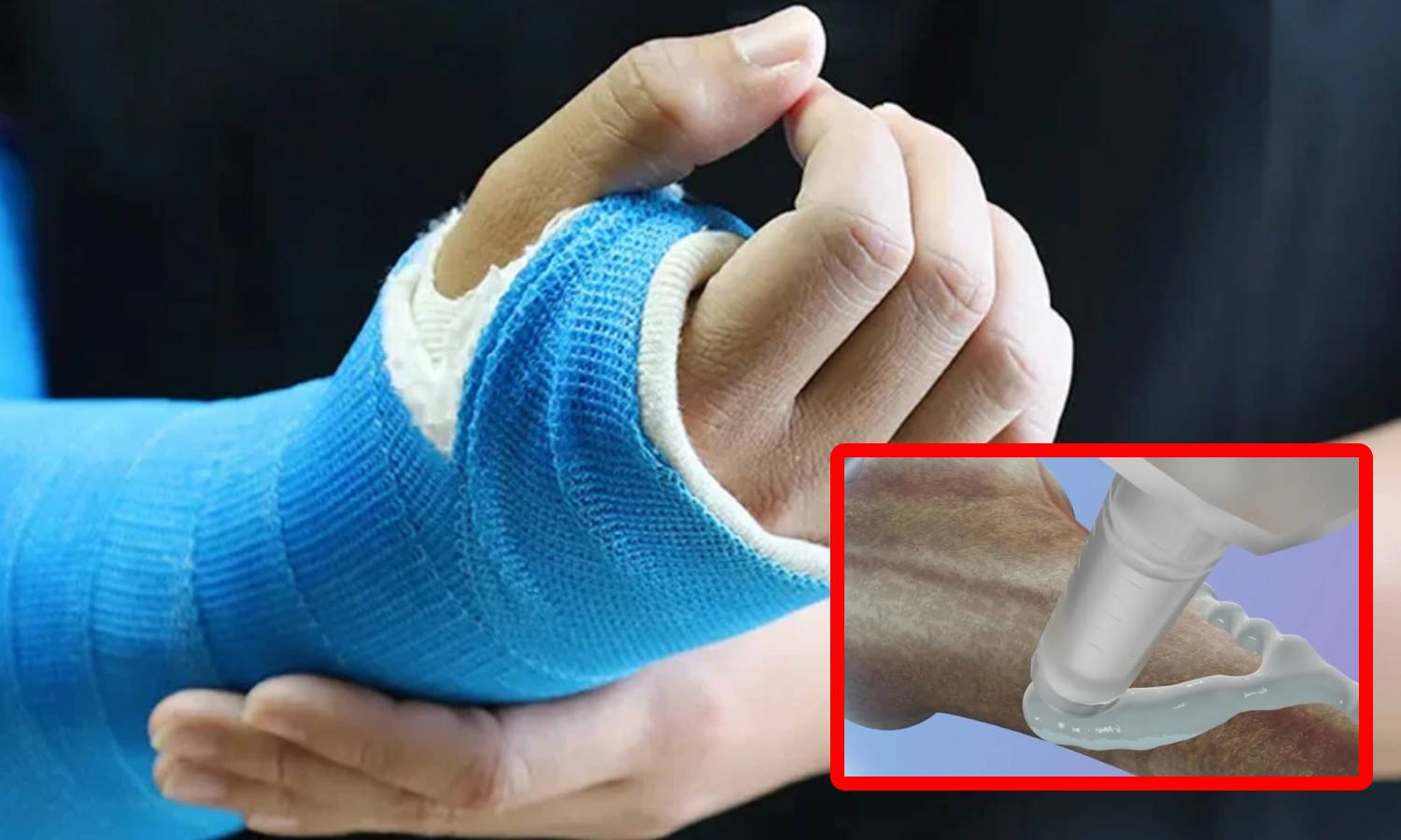 எலும்பு முறிவை 3 நிமிடத்தில் சரிசெய்யலாம் - புதிய பசையை கண்டுபிடித்த சீன விஞ்ஞானிகள் எலும்பு முறிவை 3 நிமிடத்தில் சரிசெய்யலாம் - புதிய பசையை கண்டுபிடித்த சீன விஞ்ஞானிகள்