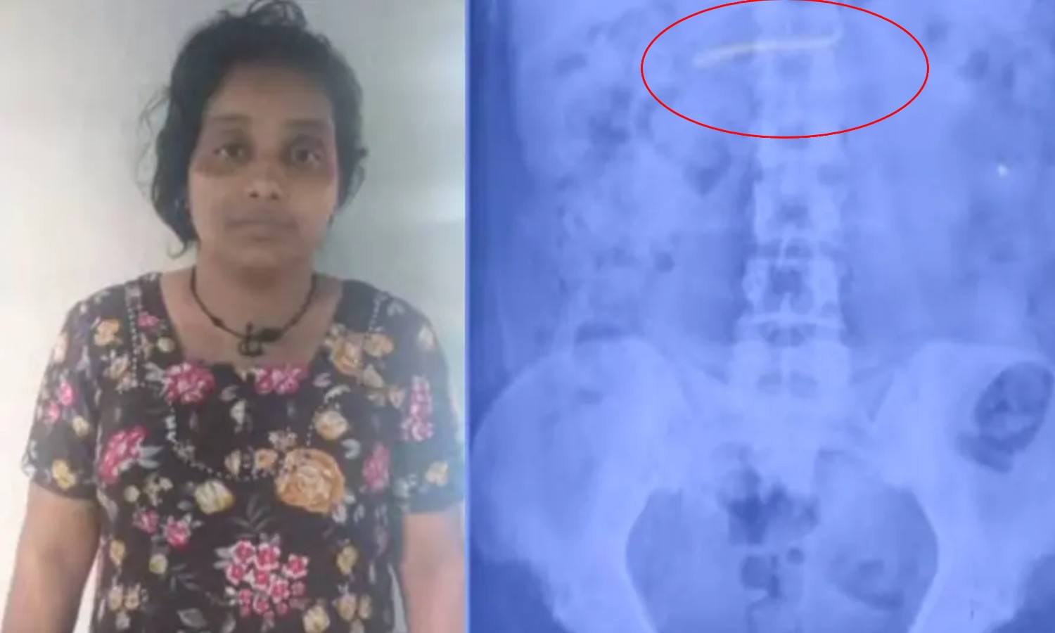 மருத்துவமனையில் நகையை திருடி வாயில்போட்டுக்கொண்ட பெண்... எக்ஸ்ரே மூலம் கண்டறிந்த போலீசார்!