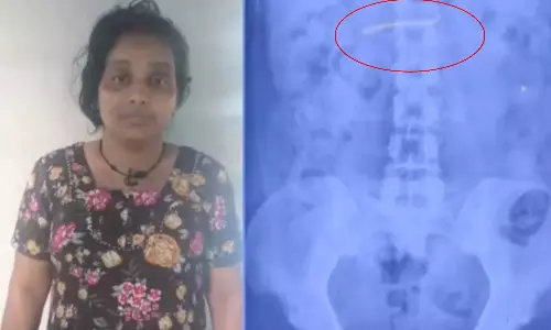 மருத்துவமனையில் நகையை திருடி வாயில்போட்டுக்கொண்ட பெண்... எக்ஸ்ரே மூலம் கண்டறிந்த போலீசார்!