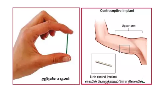 பெண்களுக்கான நவீன இலவச கருத்தடை சாதனம் அறிமுகம்
