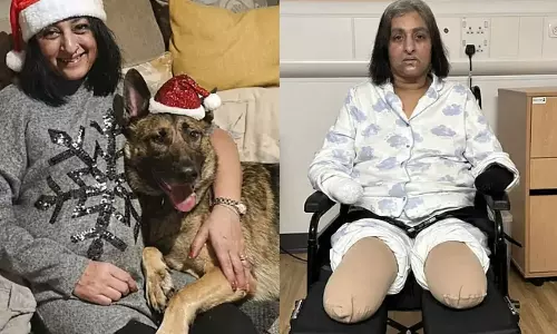 வளர்ப்பு நாய் நக்கியதால் தொற்று.. கை, கால்களை இழந்த பெண்