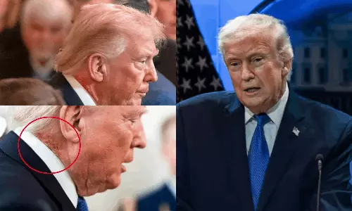 டிரம்ப் கழுத்தில் தென்பட்ட மாற்றம் - வெள்ளை மாளிகை அறிக்கையால் வெளிவந்த உண்மை!